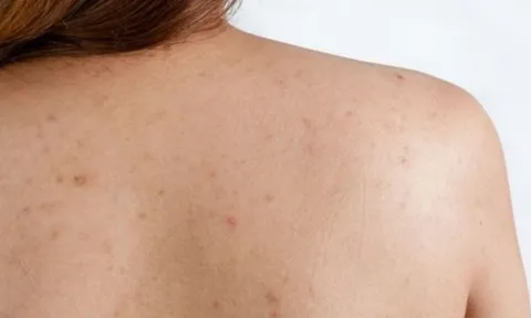 Mụn lưng bùng phát vào mùa hè: Những cách chăm sóc giúp da cơ thể thông thoáng hơn