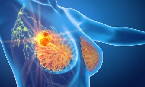 “Thủ phạm” gây K tuyến vú nhiều nhất ở phụ nữ
