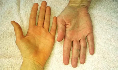 6 dấu hiệu trên cơ thể cảnh báo gan của bạn đang kêu cứu: Nên đi khám gấp