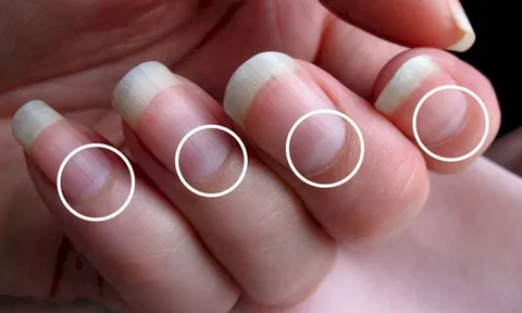 5 dấu hiệu trên móng tay chứng tỏ bạn đang mắc bệnh nan y