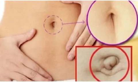 Nhìn tướng rốn 3 giây biết tương lai bạn giàu sang hay nghèo khổ