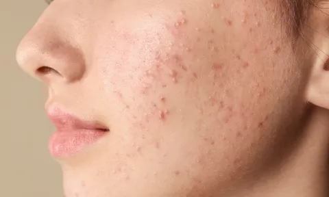 5 cách giúp giảm mụn cám tại nhà, hỗ trợ da thông thoáng và mịn màng hơn
