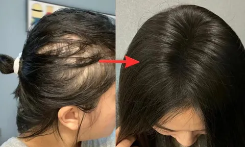 Lời khuyên dành phụ nữ có tóc rụng nhiều, mọc chậm, tóc càng ngày càng mỏng