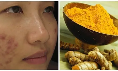 Cách trị sẹo tại nhà đơn giản, giúp da mịn màng hơn mỗi ngày