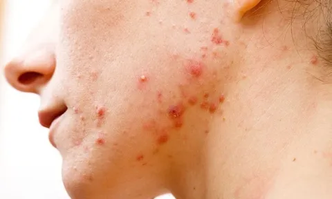 4 cách chăm sóc da khi bị mụn nhọt để hạn chế thâm sẹo và giúp da hồi phục nhanh hơn