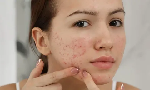 Cách làm mờ thâm mụn bằng kem đánh răng tại nhà