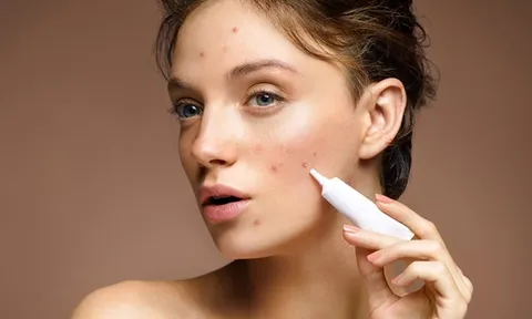 6 cách giúp làm mờ thâm sau mụn và phục hồi làn da sáng khỏe hiệu quả hơn