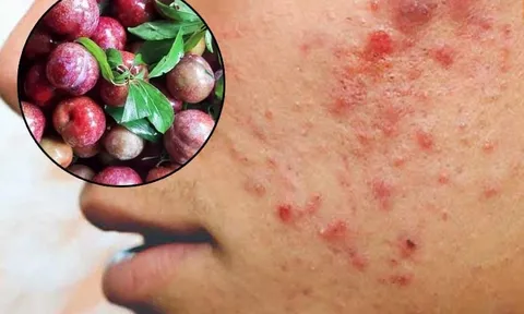 3 đối tượng không được ăn mận: Dễ nổi mụn, nóng trong