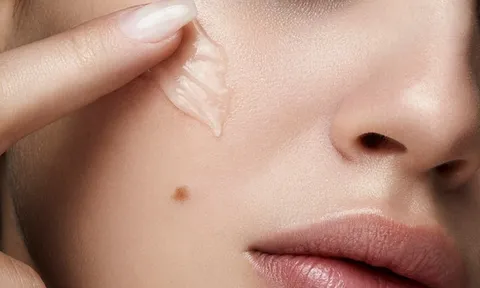 5 cách hỗ trợ làm mờ thâm lâu năm, giúp làn da đều màu và rạng rỡ hơn