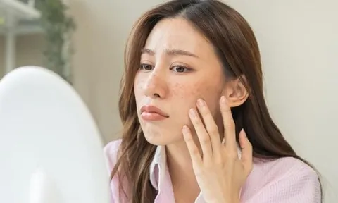 3 sai lầm chăm sóc da nhiều người mắc phải vào mùa hè khiến da đổ dầu, nổi mụn và nhanh lão hóa
