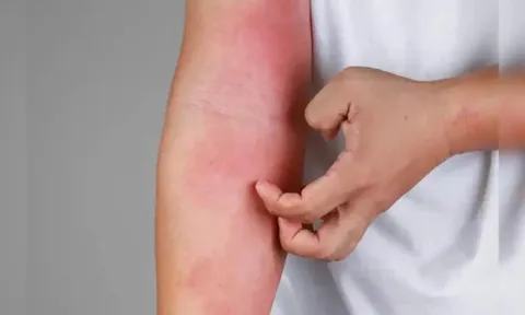 4 dấu hiệu cảnh báo bạn đang bị suy thận: Kiểm tra ngay xem bạn có không?