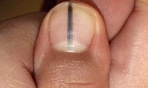 5 dấu hiệu trên móng tay cảnh báo bệnh nan y: Có 1 trong 5 dấu hiệu cũng nên đi khám gấp