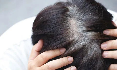 Tóc bạc sớm ở 3 vị trí này có thể là dấu hiệu gan, thận suy yếu