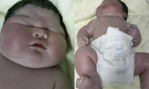 Chào đời nặng 13kg, da tím tái, bé sơ sinh khiến bác sĩ phải thốt lên: "Chưa từng thấy"