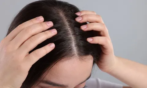 Nguyên nhân gội đầu xong vẫn nhiều gàu và ngứa