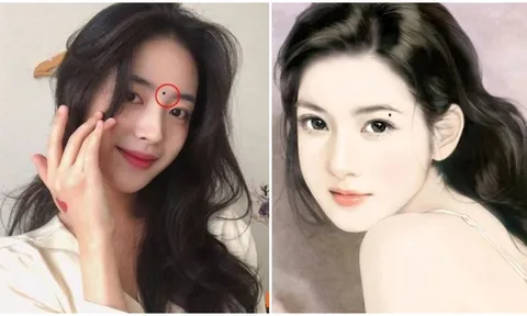 3 nốt ruồi trên mặt mang tới may mắn: Đừng dại xóa đi