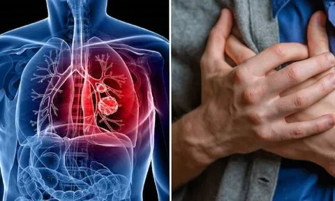 5 dấu hiệu nguy hiểm cảnh báo ung thư phổi, không phải ho như nhiều người nghĩ