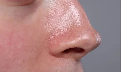 Da dầu mụn có cần dưỡng ẩm không? Nhiều người đang mắc sai lầm khiến mụn ngày càng nghiêm trọng