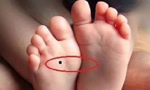 4 nốt ruồi trên chân mang tới may mắn cho bạn: Ai có thật đáng chúc mừng