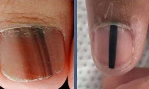 Cảnh báo từ Bác sĩ Da liễu Trung ương: 5 dấu hiệu trên móng tay có thể là "án tử" ung thư ác tính