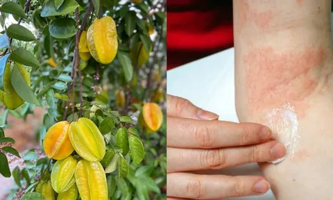  Mách mẹo làm giảm rôm sảy, mẩn ngứa bằng lá khế: Dân gian dùng nhiều nhưng cần biết đúng cách