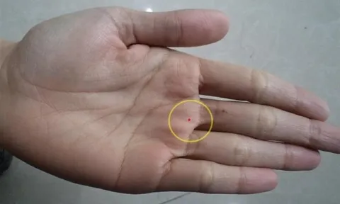 4 nốt ruồi trên bàn tay mang tới may mắn cho bạn: Ai có thật đáng chúc mừng