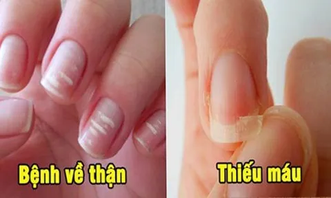 Bắt bệnh qua móng tay: Có 1 dấu hiệu cũng nên đi khám sớm
