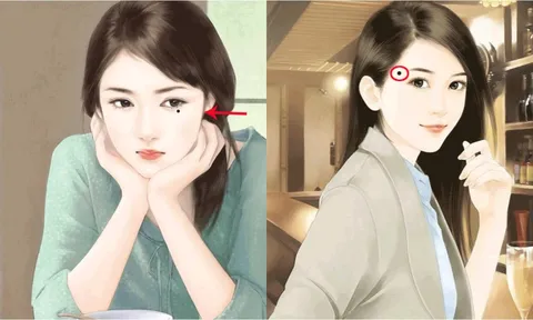 3 nốt ruồi trên mặt mang tới may mắn cho chủ nhân: Đừng dại xóa đi