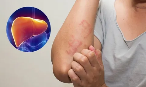 4 dấu hiệu cảnh báo bệnh gan: Có 1/4 cũng nên đi khám sớm