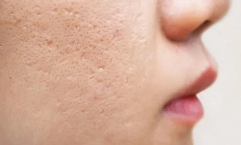 3 lầm tưởng phổ biến về điều trị sẹo mụn khiến nhiều người tốn thời gian mà hiệu quả không như mong đợi