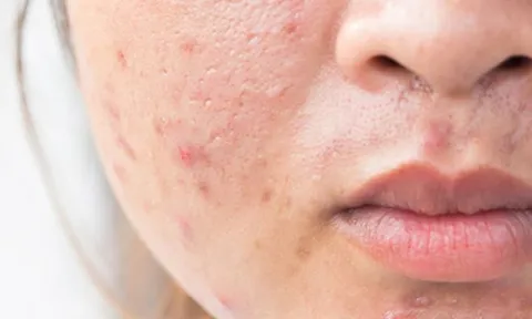 Muốn ngăn mụn tái phát? Đừng bỏ qua 6 bước chăm sóc da giúp duy trì làn da khỏe mạnh