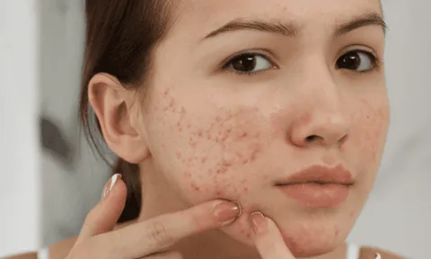 Muốn giảm mụn và hạn chế tái phát, đừng bỏ qua 3 hoạt chất quan trọng trong chu trình chăm sóc da