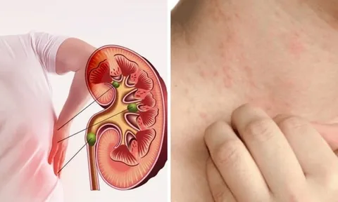 3 dấu hiệu cảnh báo suy thận giai đoạn nặng