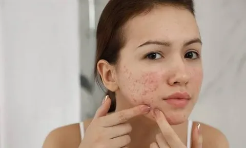 7 loại mặt nạ thiên nhiên hỗ trợ làm mờ thâm mụn, giúp da sáng khỏe tại nhà