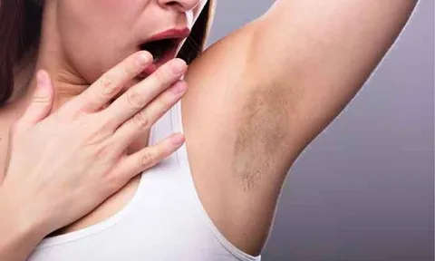 Nguyên nhân khiến vùng da dưới cánh tay thâm sạm và những cách chăm sóc đơn giản tại nhà
