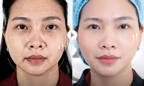 Căng da không phẫu thuật -Công nghệ 5.5.10: Vì sao trở thành xu hướng trẻ hóa được phụ nữ sau 40 tuổi lựa chọn?