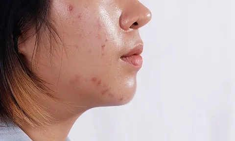 4 thói quen khiến da dầu dễ nổi mụn hơn mỗi ngày, nhiều người vẫn vô tình mắc phải