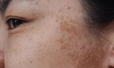 5 thói quen hằng ngày âm thầm khiến làn da dễ bị nám, nhiều người vẫn lặp lại mà không hay biết