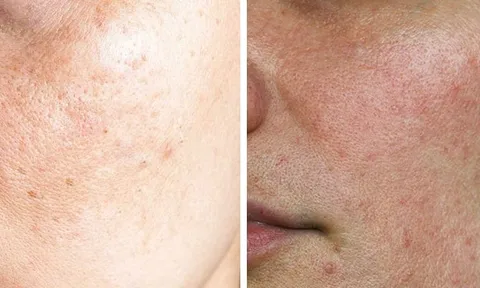 3 nguyên tắc chăm sóc da giúp cải thiện nám sau sinh và lấy lại làn da sáng khỏe