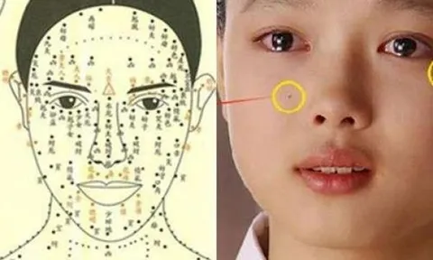 3 nốt ruồi hao tài khánh kiệt nên hóa giải