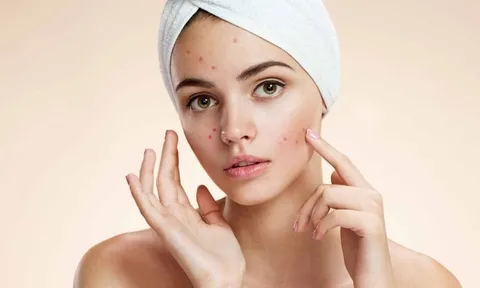Nặn mụn xong đừng vội làm điều này nếu không muốn da thâm lâu và dễ để lại sẹo