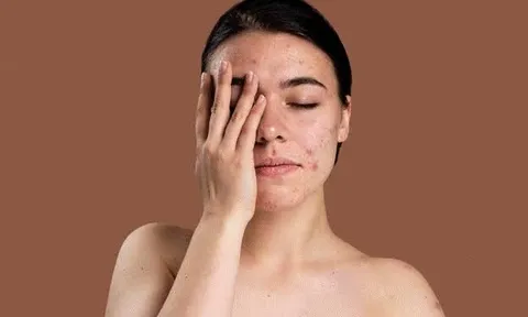 Kem chấm mụn có thực sự hiệu quả? Cách chọn và sử dụng đúng để mụn nhanh phục hồi