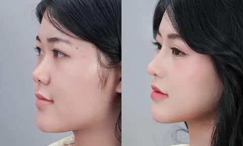“Xóa mũi tẹt cho thanh thiếu niên Việt”: Hàng loạt bạn trẻ tự tin hơn sau nâng mũi sụn sườn J-Cos