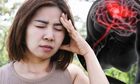 Chóng mặt tưởng bị rối loạn tiền đình, sau 3 ngày người phụ nữ bất ngờ khi biết bị nhồi máu não