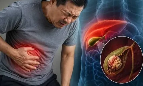 3 dấu hiệu cảnh báo viêm túi mật nặng