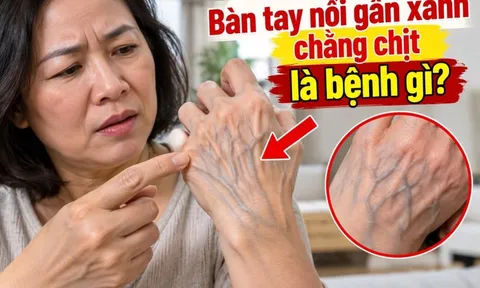 Bàn tay nổi gân xanh chằng chịt là bệnh gì?