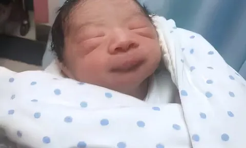 Tiểu công chúa chào đời kèm 1 bào thai nữa dính chặt vào mông, bác sĩ cũng ngỡ ngàng: Cực hiếm gặp!