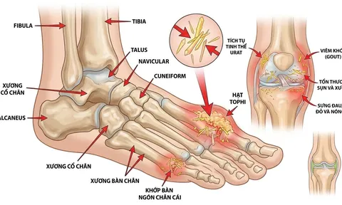 Acid uric tăng cao: 5 biểu hiện dễ bị bỏ qua, nhiều người chỉ phát hiện khi gout đã xuất hiện
