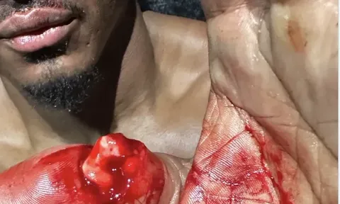 Chấn thương rùng rợn của Alonzo Menifield tại UFC 331: Nỗi ám ảnh và ý chí thép của một chiến binh
