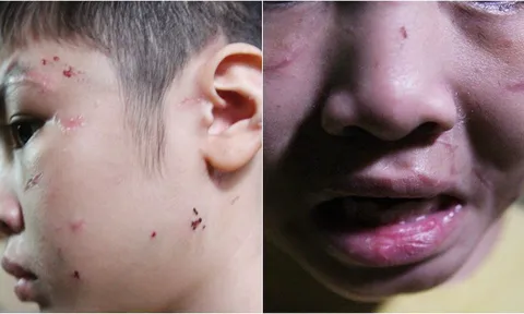 Bé trai với chi chít vết sẹo, lỗ thủng trên cơ thể nghi bị cha đẻ bạo hành